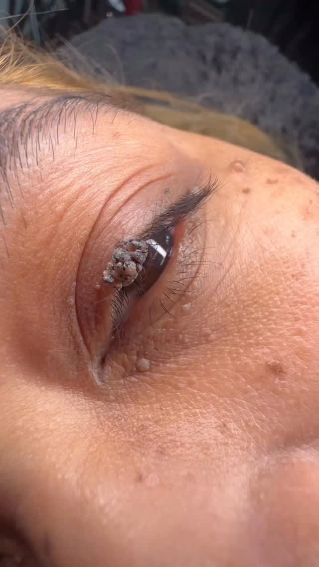 Post 1 by HALINA THE CUPPING CLINIC on Instagram (video)