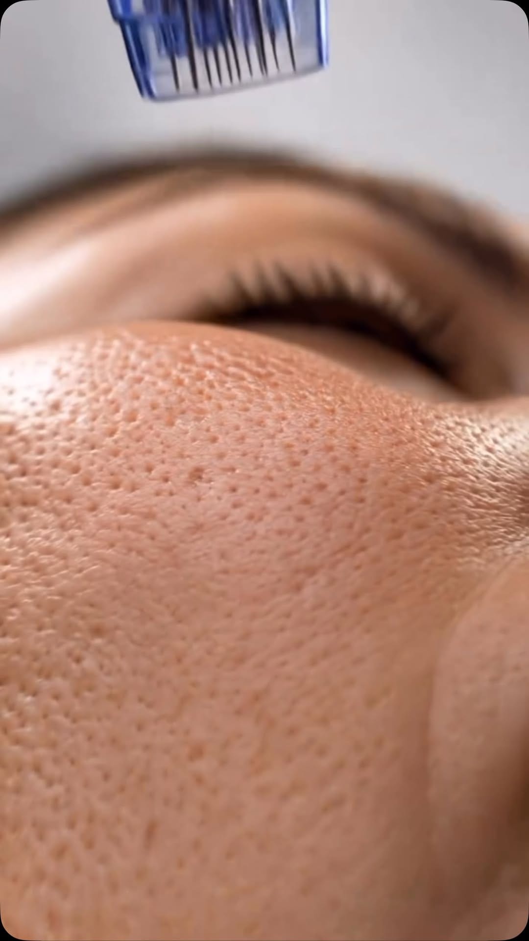Post 9 by HALINA THE CUPPING CLINIC on Instagram (video)