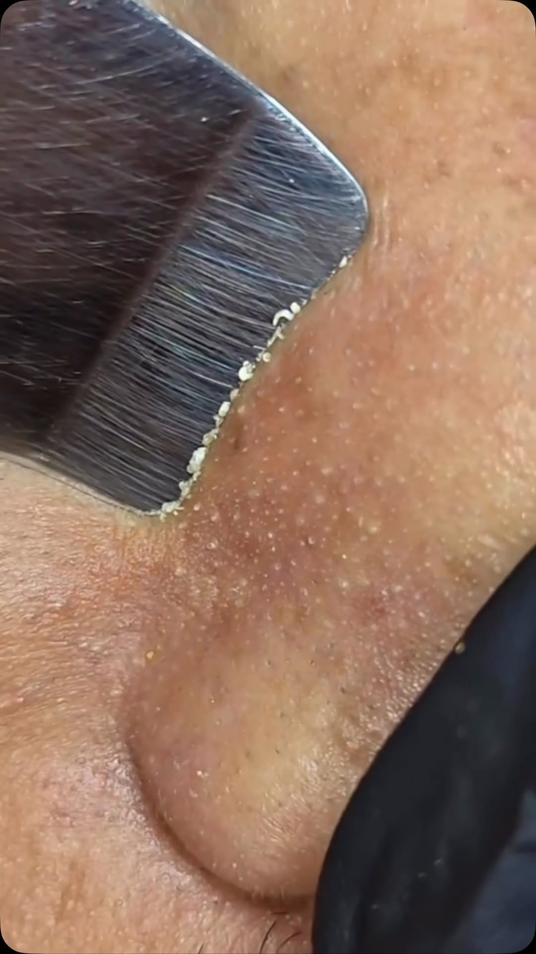 Post 10 by HALINA THE CUPPING CLINIC on Instagram (video)
