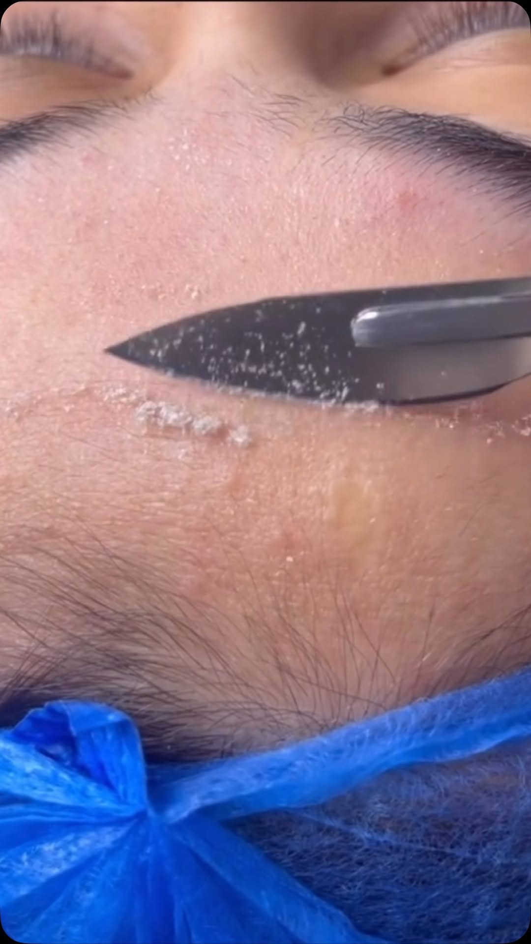 Post 4 by HALINA THE CUPPING CLINIC on Instagram (video)