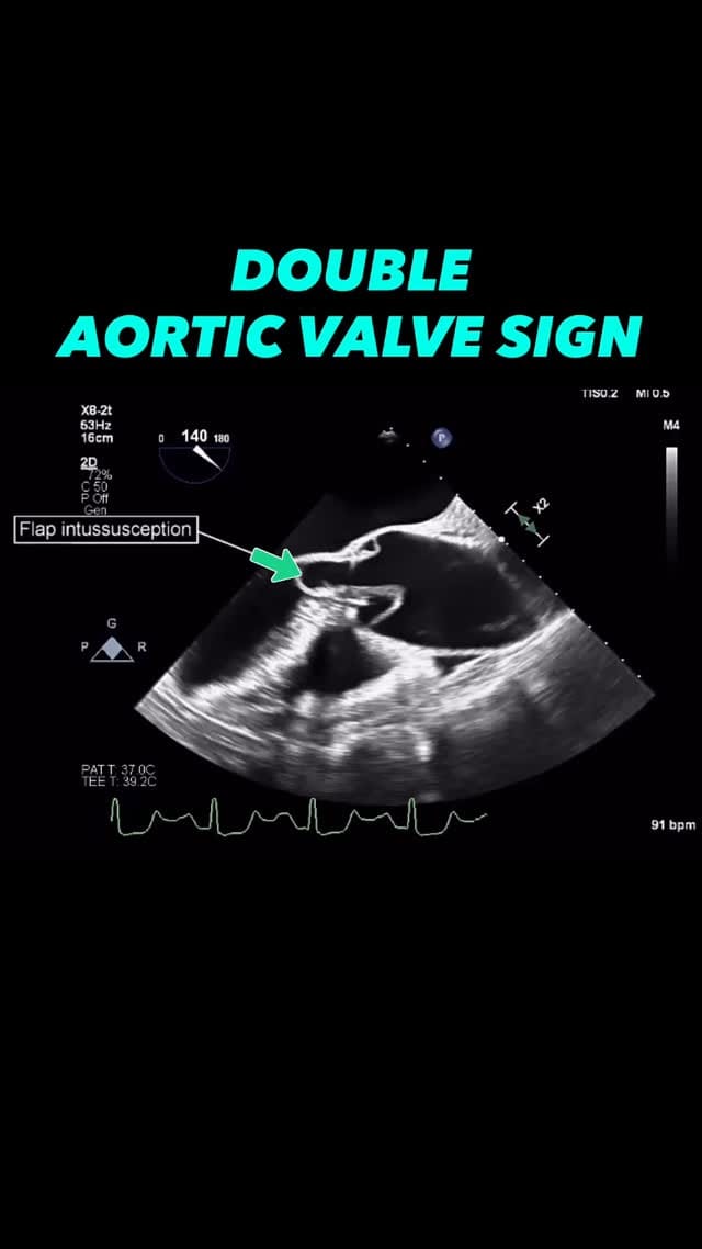 Post 7 by Antonino Di Franco, MD FACC FSIC on Instagram (video)