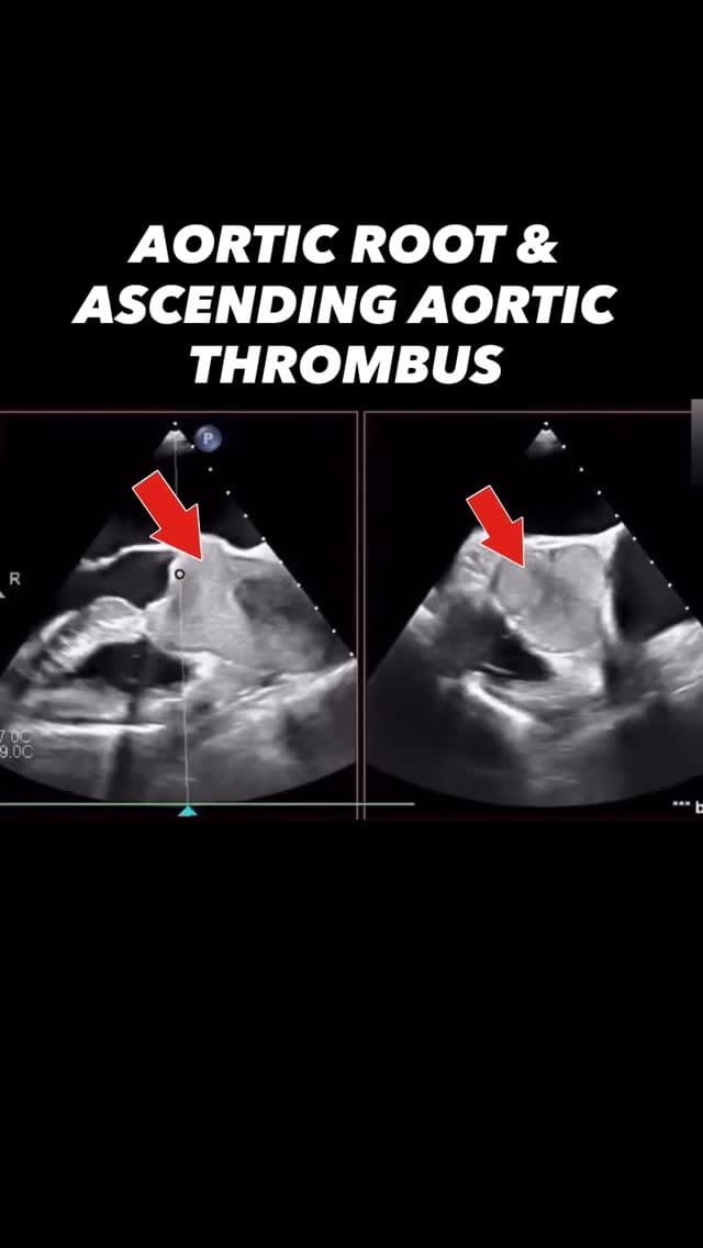 Post 8 by Antonino Di Franco, MD FACC FSIC on Instagram (video)