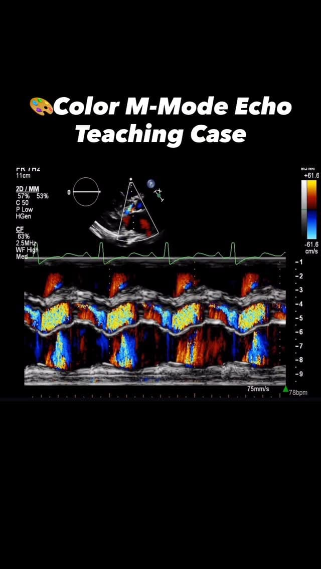 Post 6 by Antonino Di Franco, MD FACC FSIC on Instagram (video)