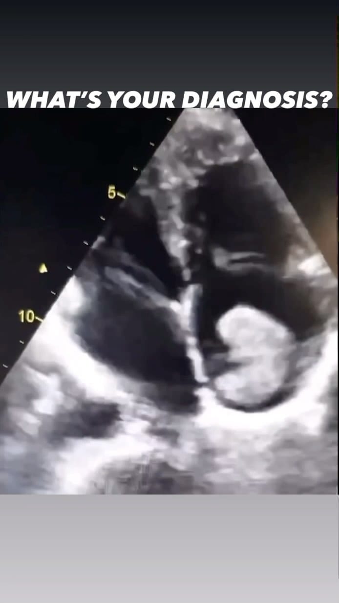 Post 10 by Antonino Di Franco, MD FACC FSIC on Instagram (video)