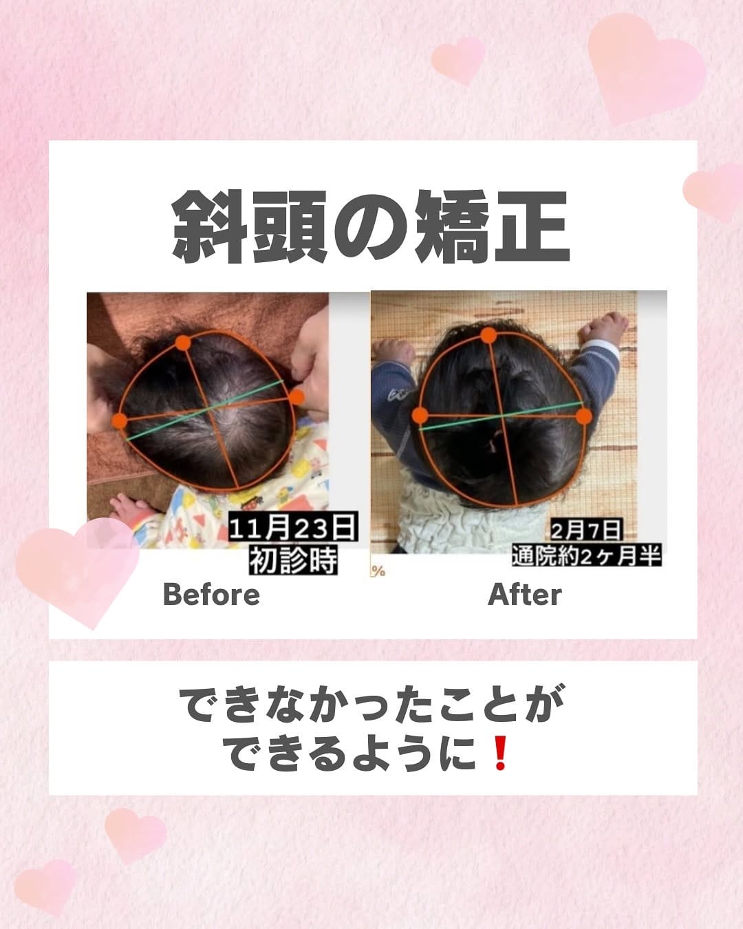 Post 10 by 《大阪・西田辺》整体院ボディーケア松本　👶🏼赤ちゃん頭のゆがみ•斜頭•絶壁・マタニティ•産後骨盤矯正専門 on Instagram (carousel)