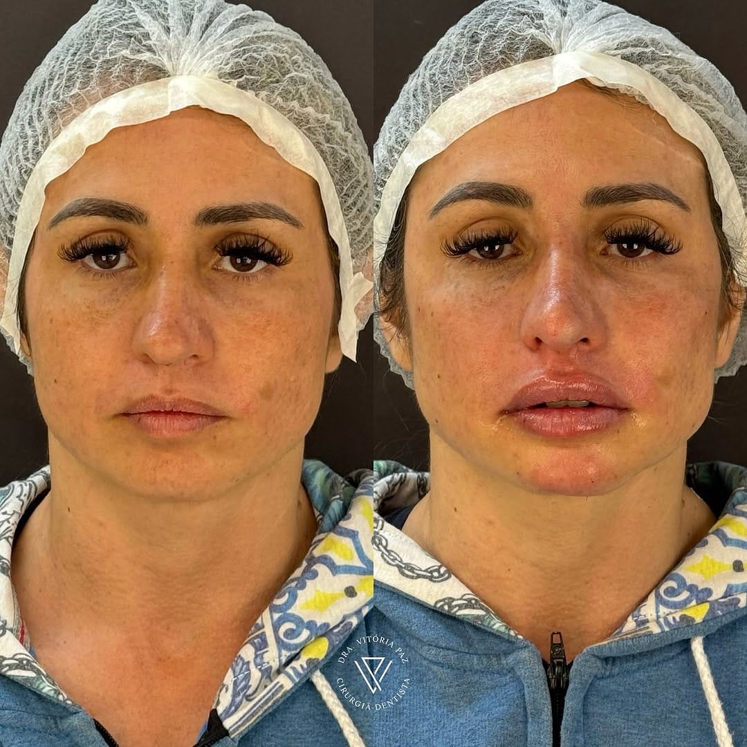 Post 8 by Drª Vitória Paz | Harmonização Orofacial on Instagram (carousel)