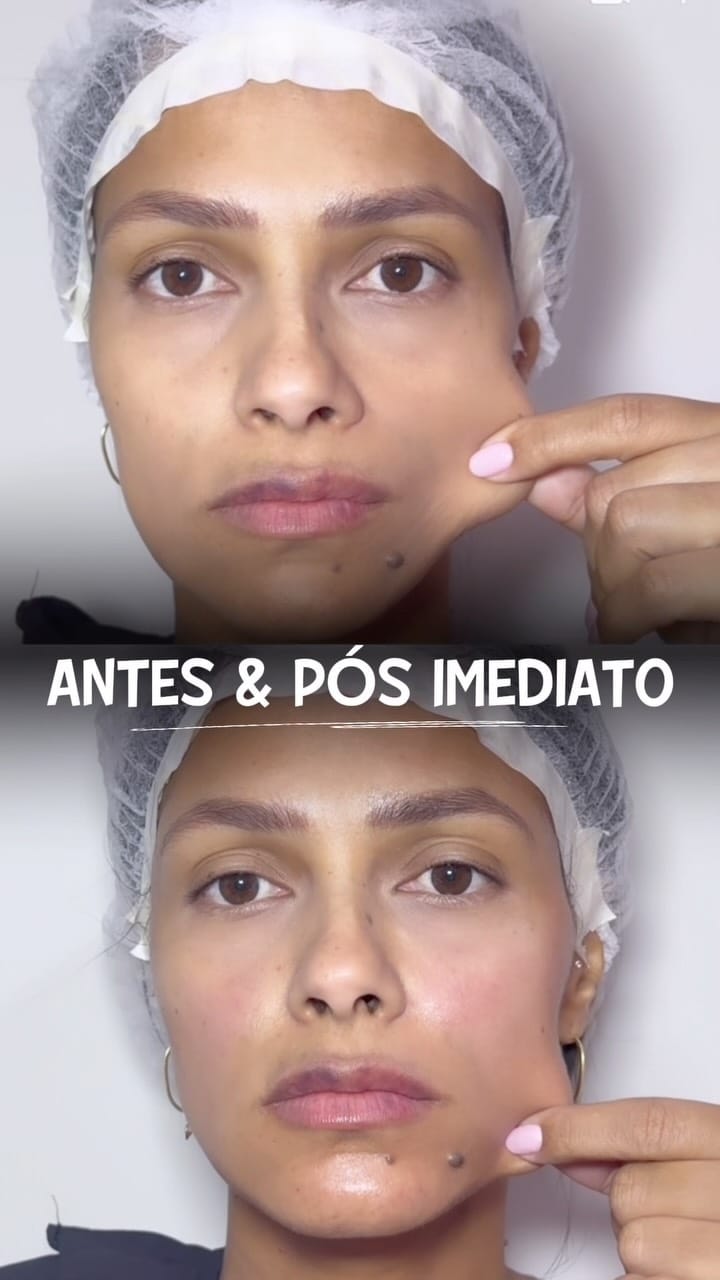 Post 5 by Drª Vitória Paz | Harmonização Orofacial on Instagram (video)