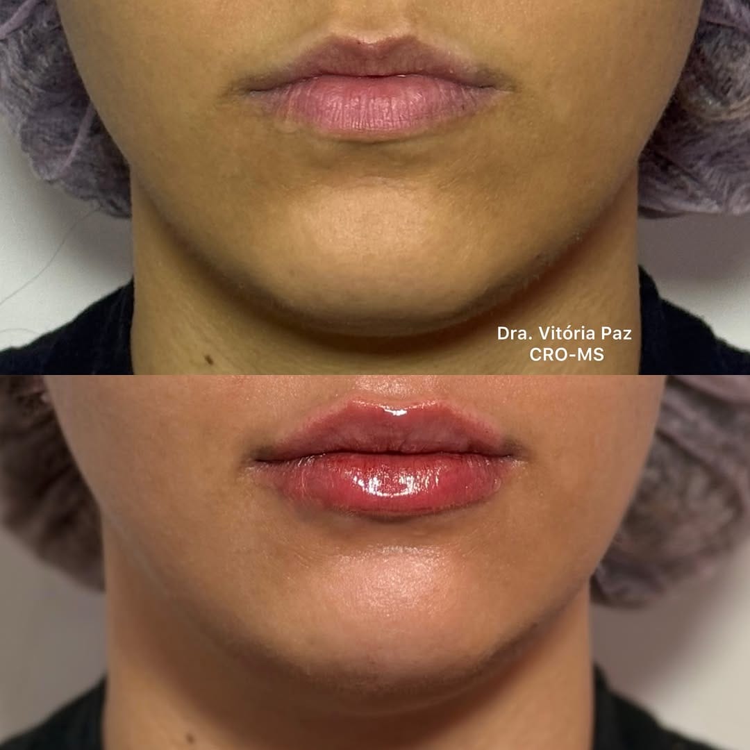 Post 3 by Drª Vitória Paz | Harmonização Orofacial on Instagram (carousel)