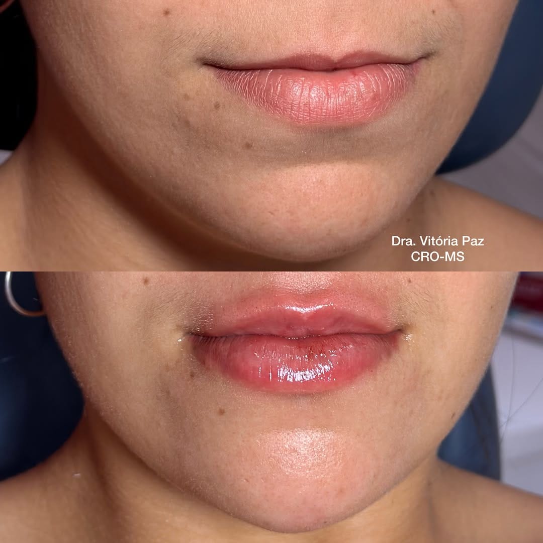 Post 6 by Drª Vitória Paz | Harmonização Orofacial on Instagram (carousel)