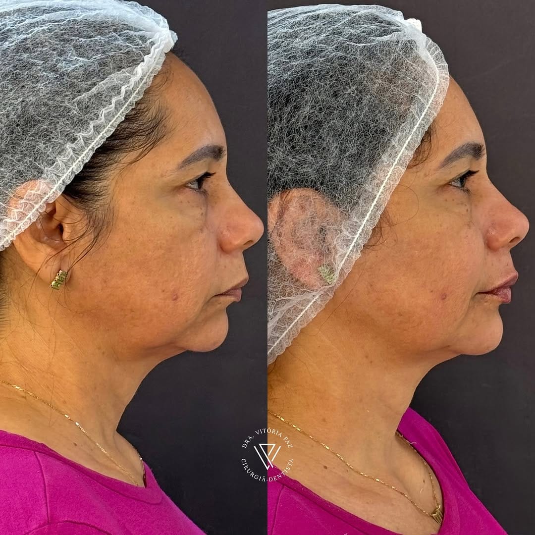 Post 9 by Drª Vitória Paz | Harmonização Orofacial on Instagram (carousel)