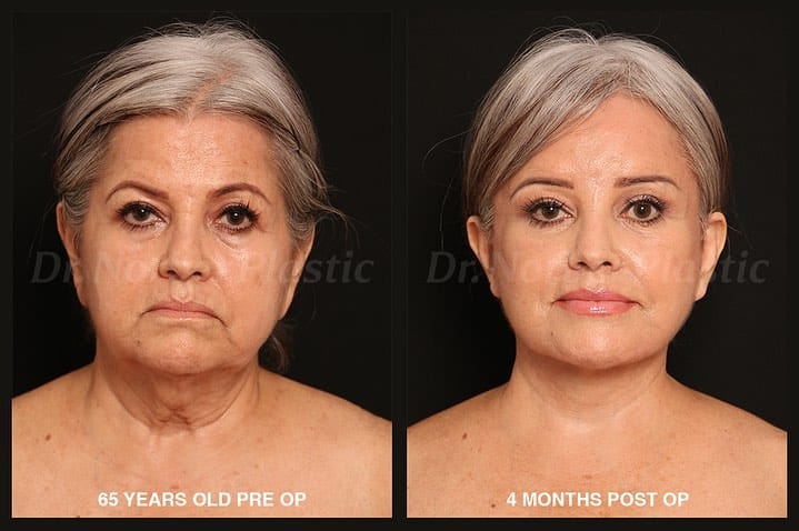 Post 10 by Dr. Norberto Hernández | Face Plastic Surgeon | Plastic Surgery on Instagram (carousel)