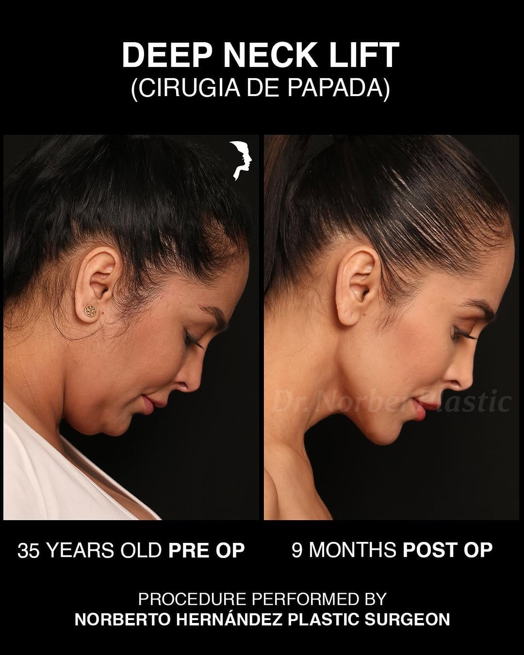 Post 8 by Dr. Norberto Hernández | Face Plastic Surgeon | Plastic Surgery on Instagram (carousel)