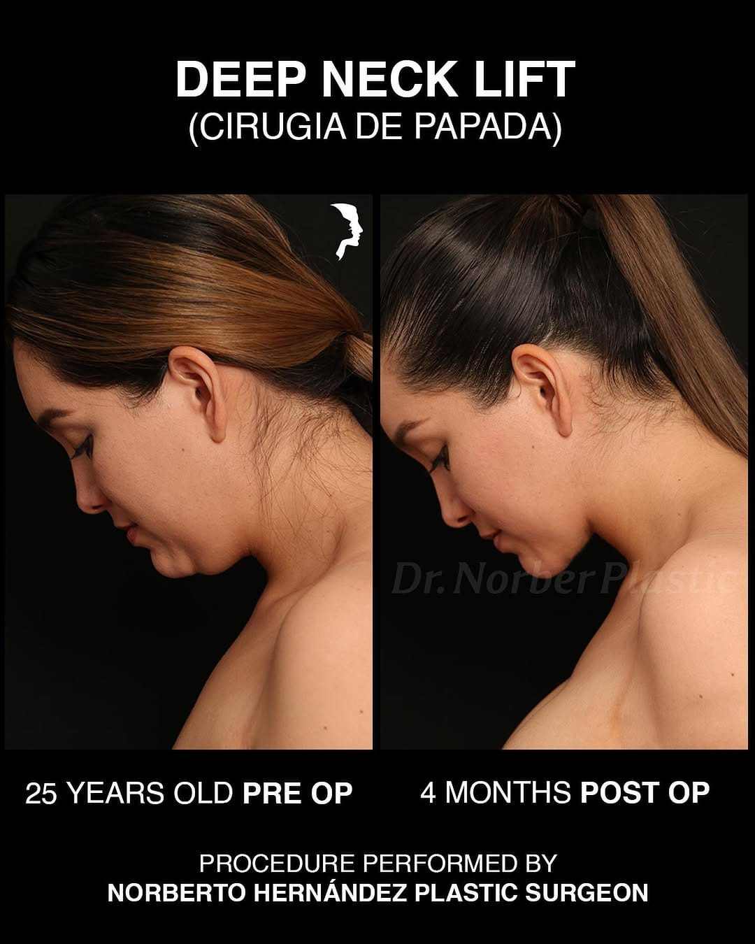 Post 9 by Dr. Norberto Hernández | Face Plastic Surgeon | Plastic Surgery on Instagram (carousel)