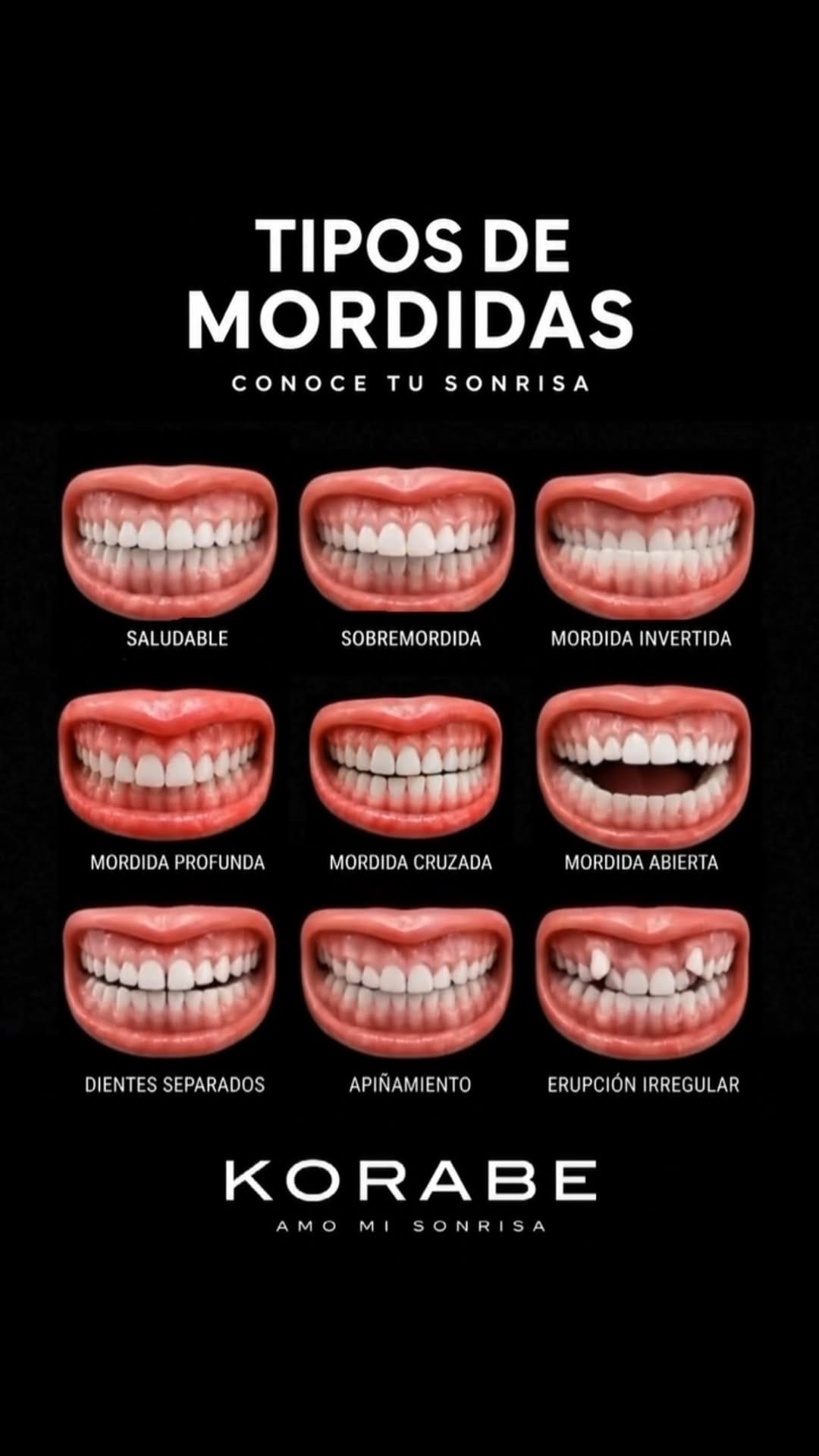 Post 5 by Dr Benavides | Carillas de Porcelana on Instagram (video)