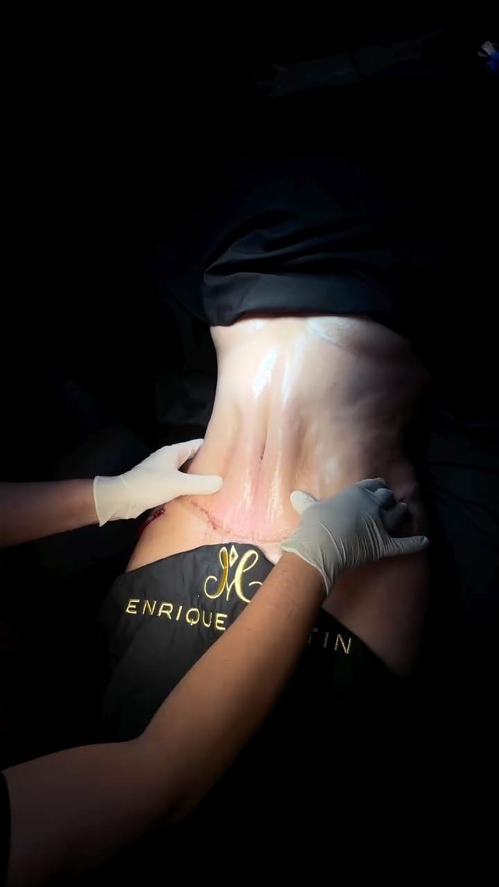 Post 8 by Dr. Enrique Martin | Cirujano Plástico on Instagram (video)