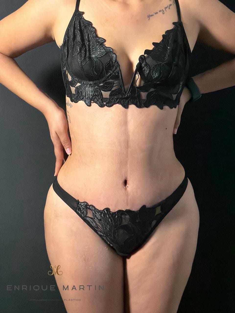 Post 9 by Dr. Enrique Martin | Cirujano Plástico on Instagram (carousel)