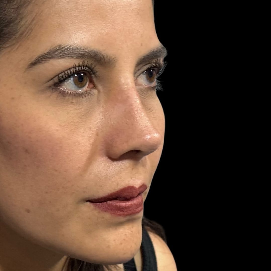 Post 6 by Dr. Lorenzo Lizárraga | Rinoplastia ultrasónica on Instagram (carousel)