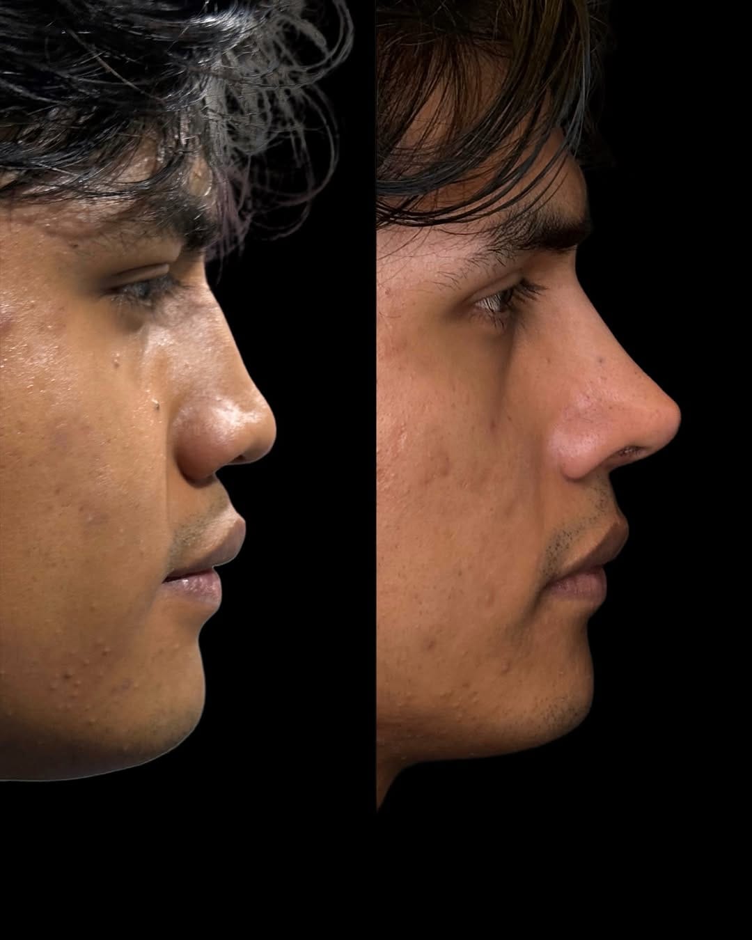 Post 4 by Dr. Lorenzo Lizárraga | Rinoplastia ultrasónica on Instagram (carousel)