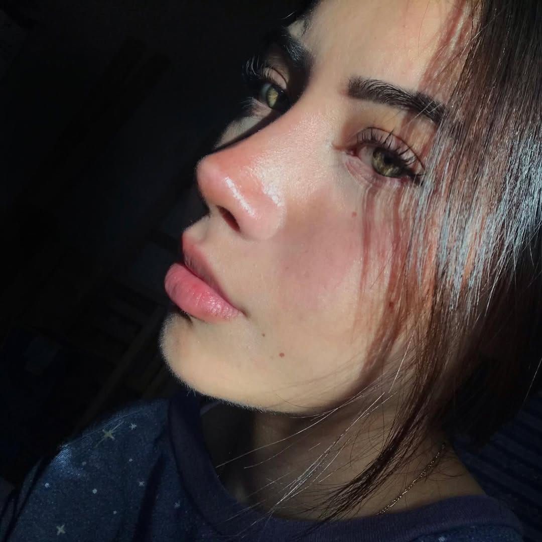 Post 10 by Dr. Lorenzo Lizárraga | Rinoplastia ultrasónica on Instagram (carousel)