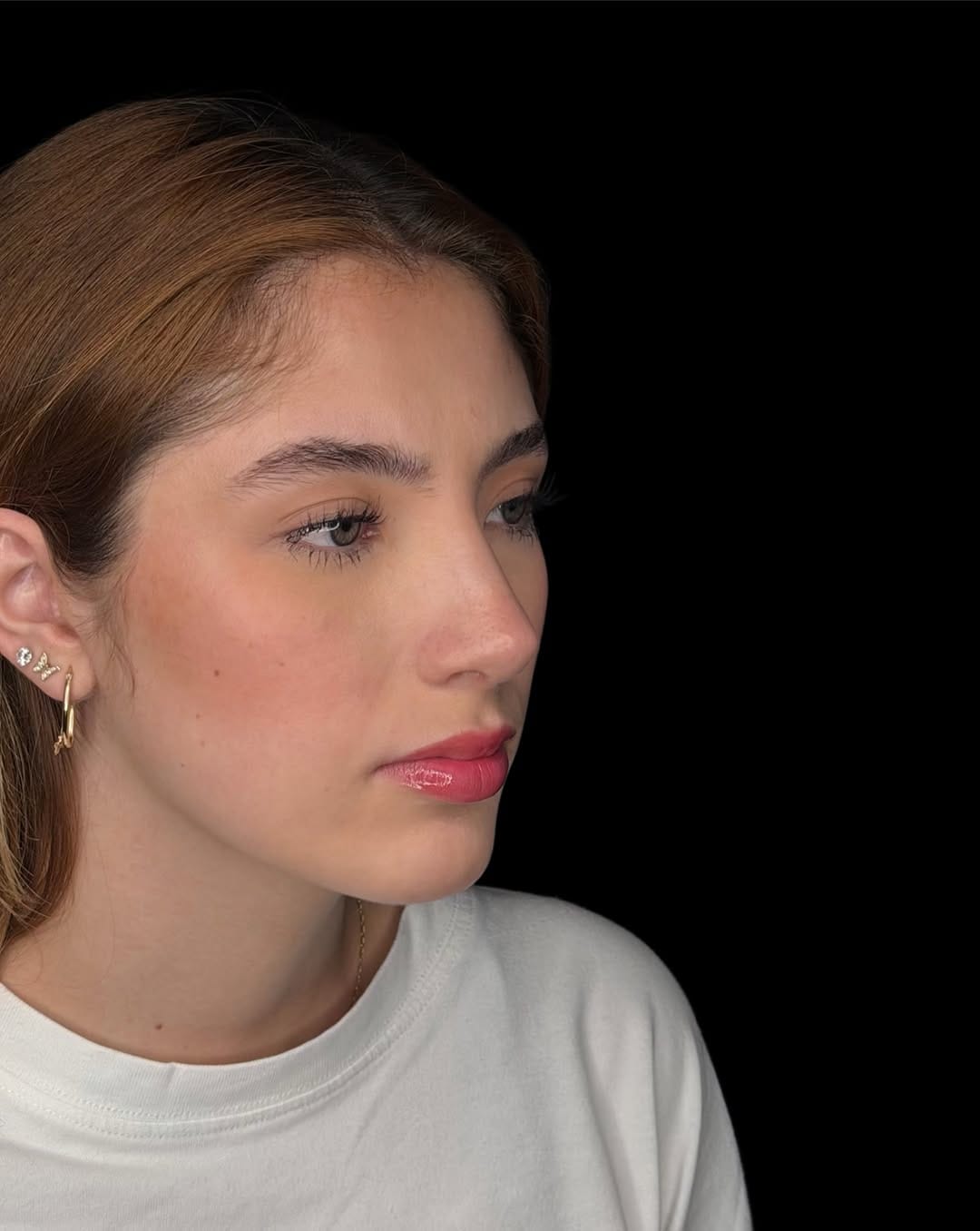 Post 1 by Dr. Lorenzo Lizárraga | Rinoplastia ultrasónica on Instagram (carousel)