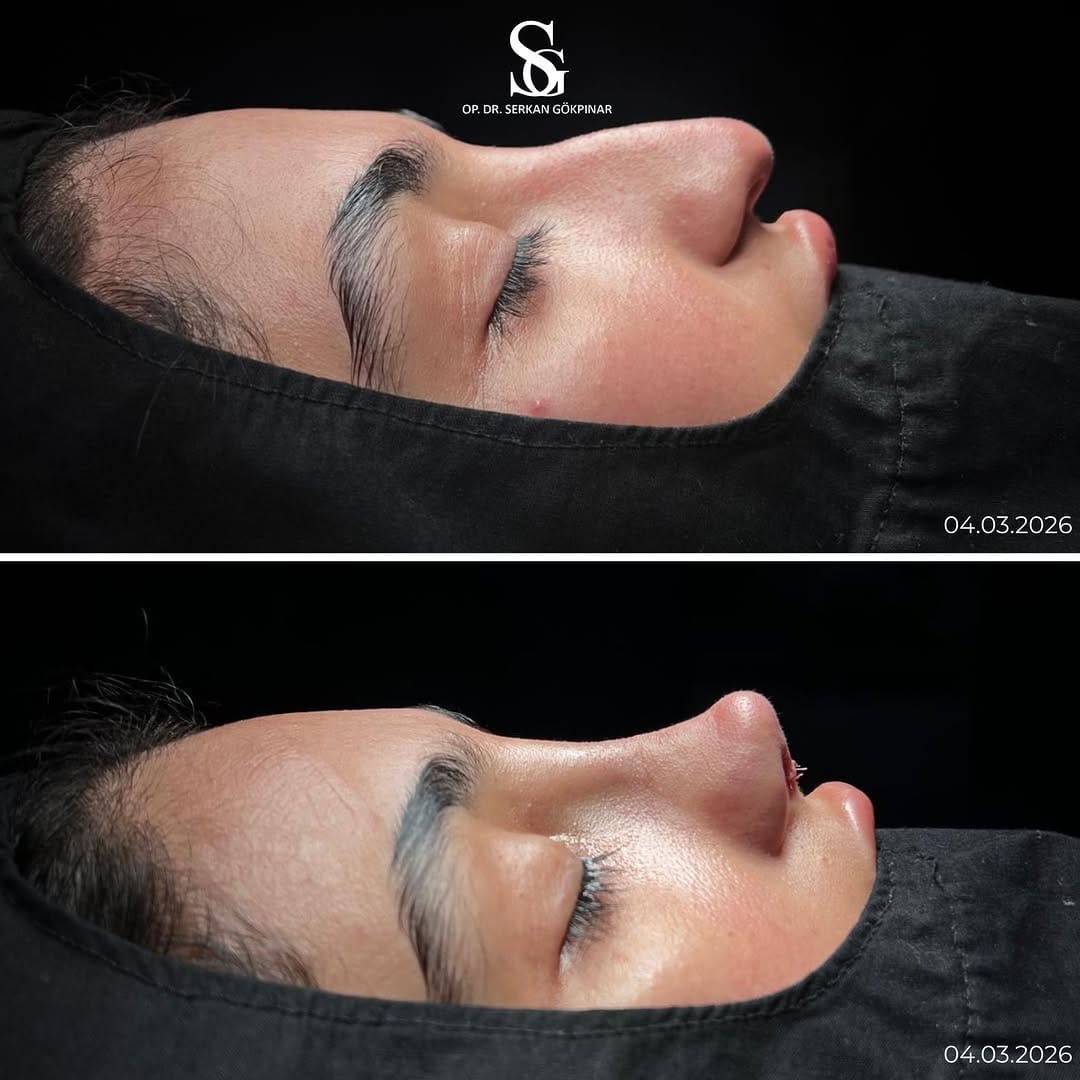 Post 9 by Op. Dr. Serkan Gökpınar | ENT Surgeon on Instagram (carousel)