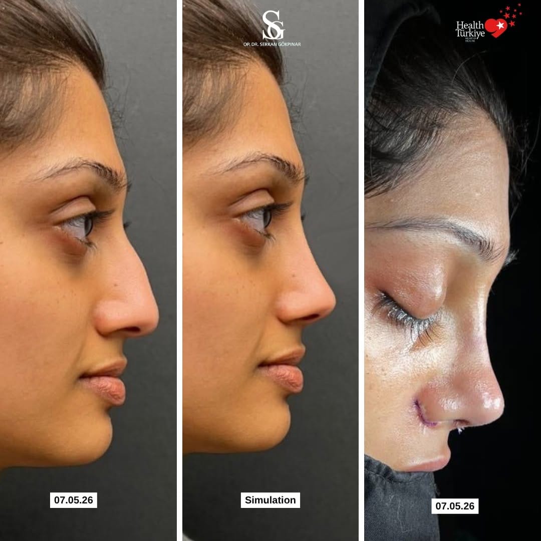 Post 5 by Op. Dr. Serkan Gökpınar | ENT Surgeon on Instagram (image)