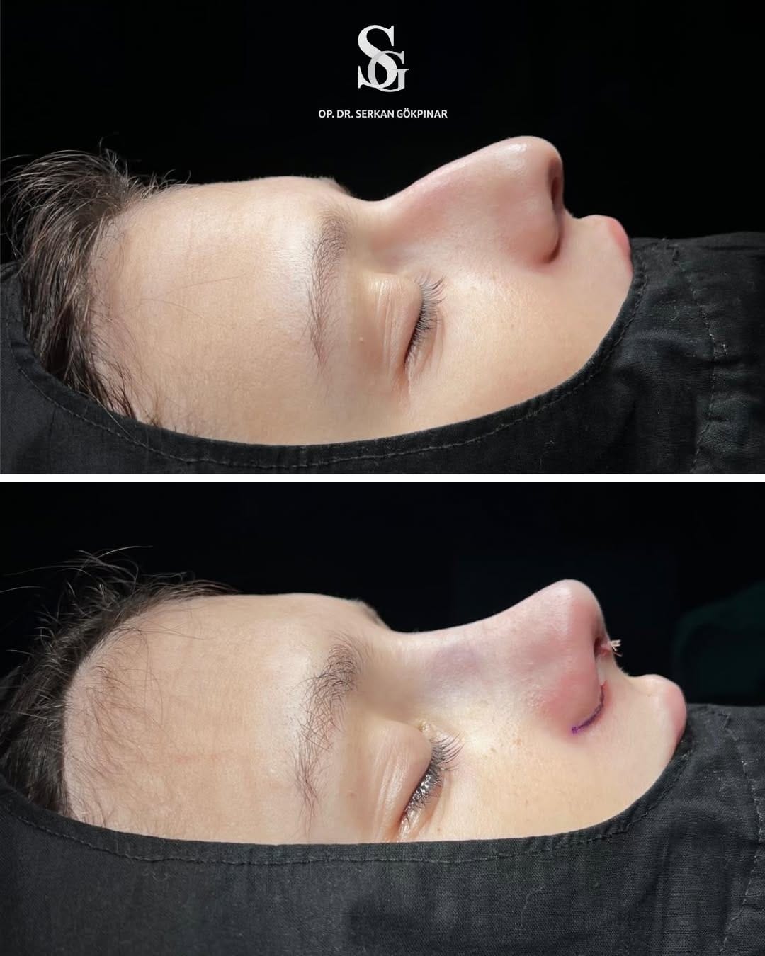 Post 10 by Op. Dr. Serkan Gökpınar | ENT Surgeon on Instagram (image)