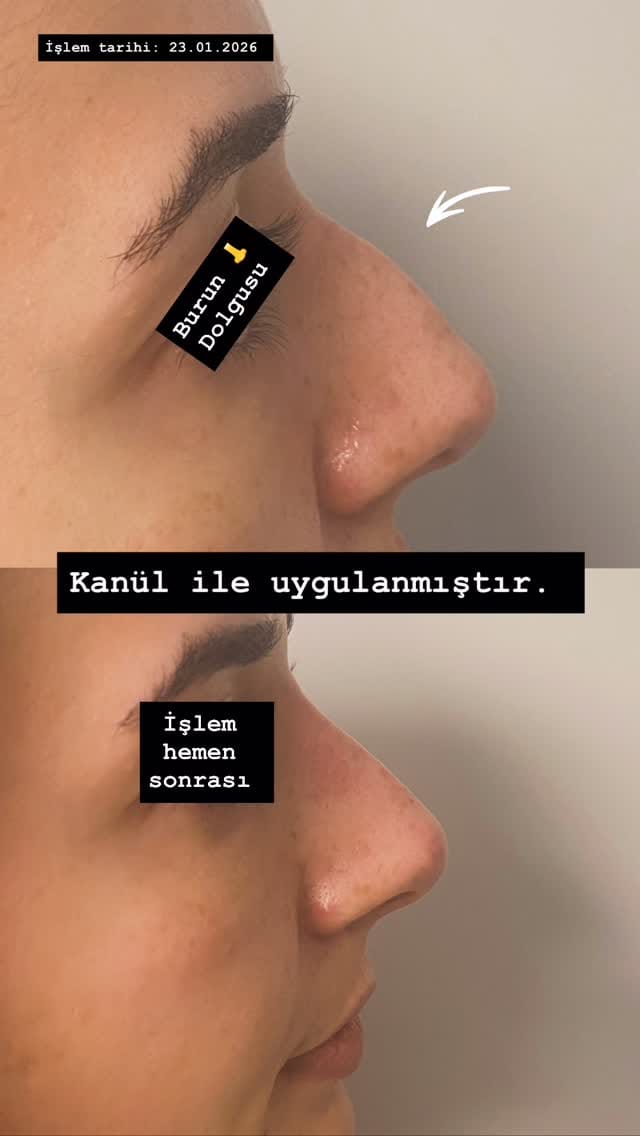 Post 4 by Dr. Zafer GÖKDEMİR Medikal Estetik Kliniği on Instagram (video)
