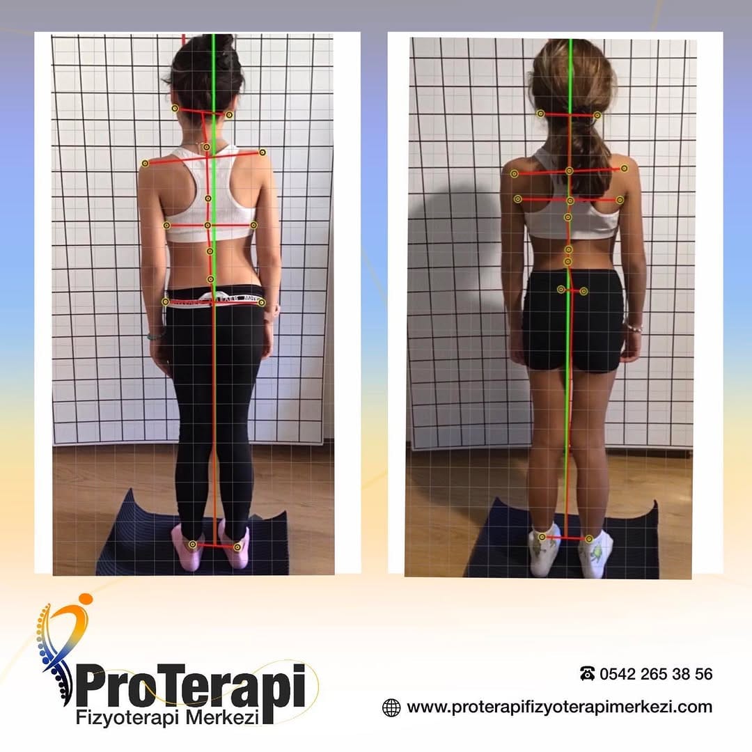 Post 4 by Proterapi Fizyoterapi on Instagram (image)