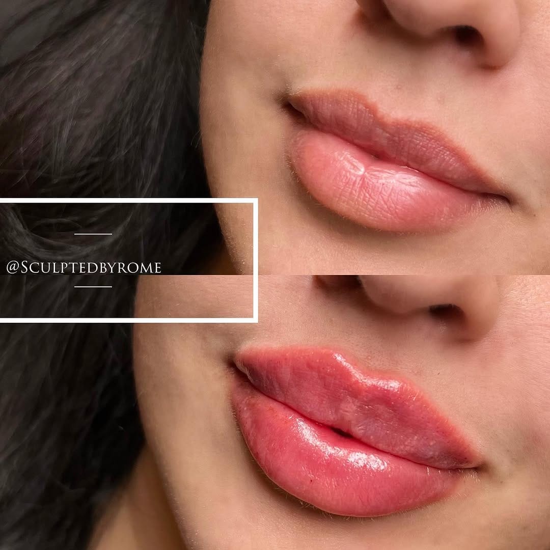 Post 10 by H A L E Y•R O M E—NURSE PRACTITIONER INJECTOR on Instagram (carousel)