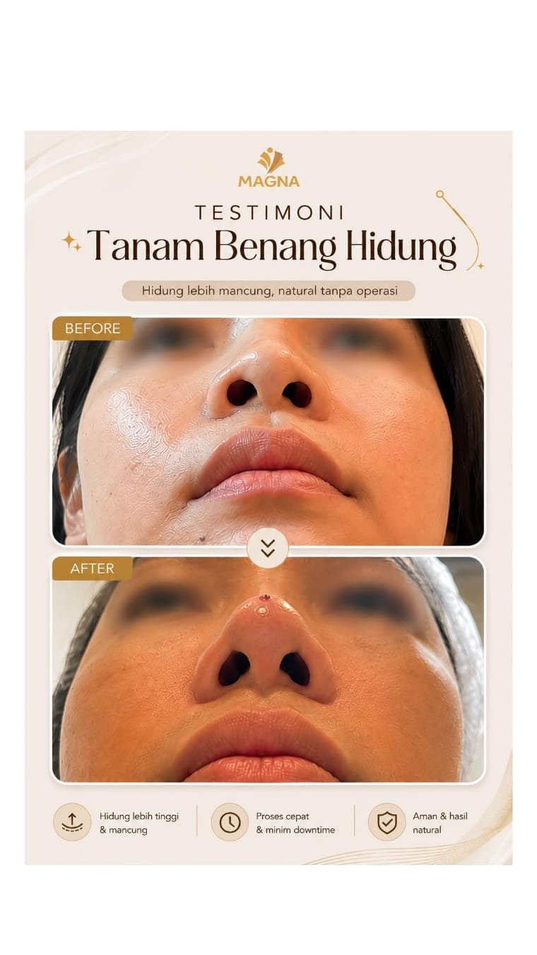 Post 5 by Klinik Kecantikan Magna on Instagram (video)