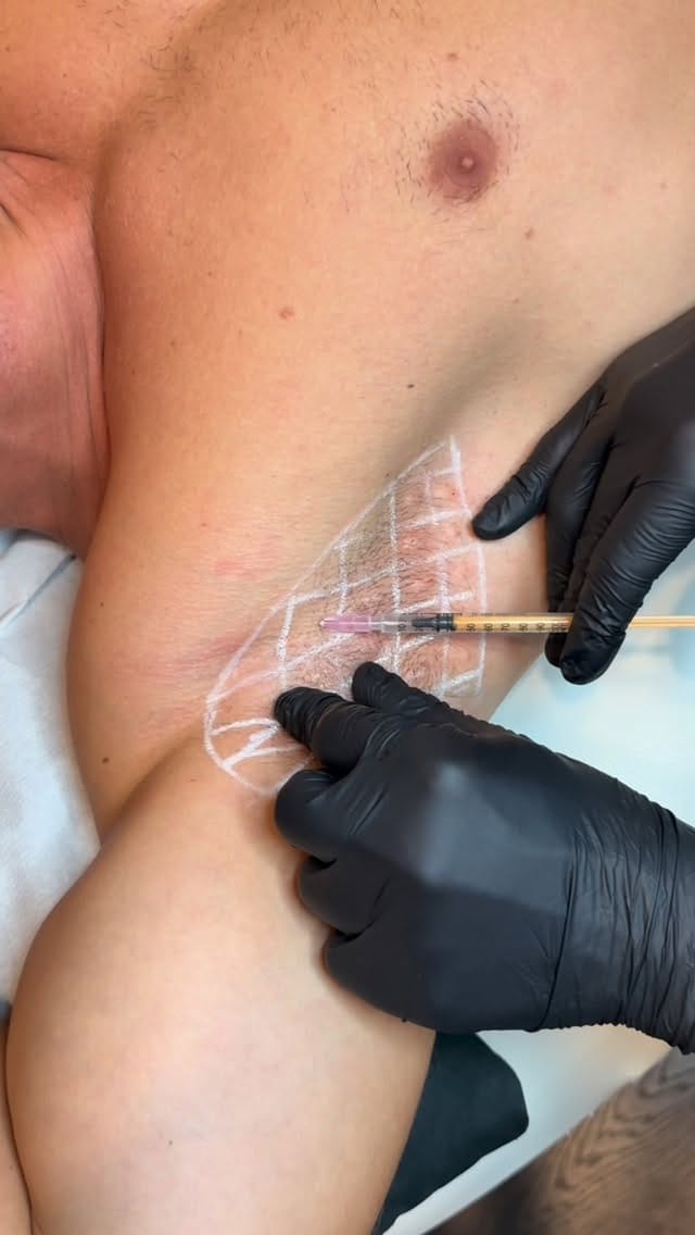 Post 4 by Dr. Renato Bortolotti on Instagram (video)