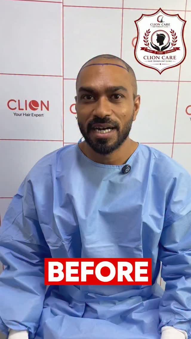 Post 7 by Clion Hair Transplant on Instagram (video)
