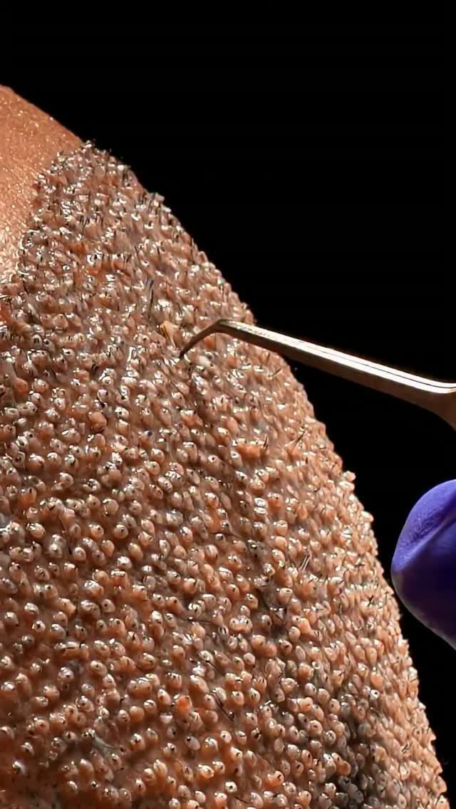 Post 8 by Clion Hair Transplant on Instagram (video)