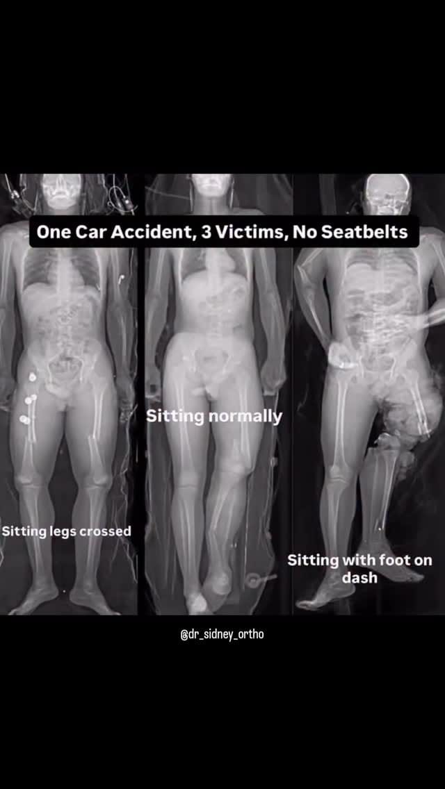 Post 10 by Dr Sidney | Orthopaedic Surgeon on Instagram (video)
